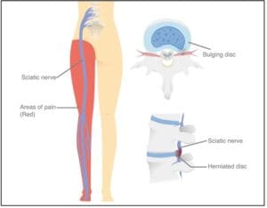 Lumbar Disc