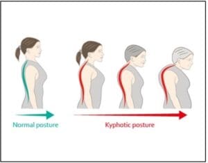Kyphosis Brace